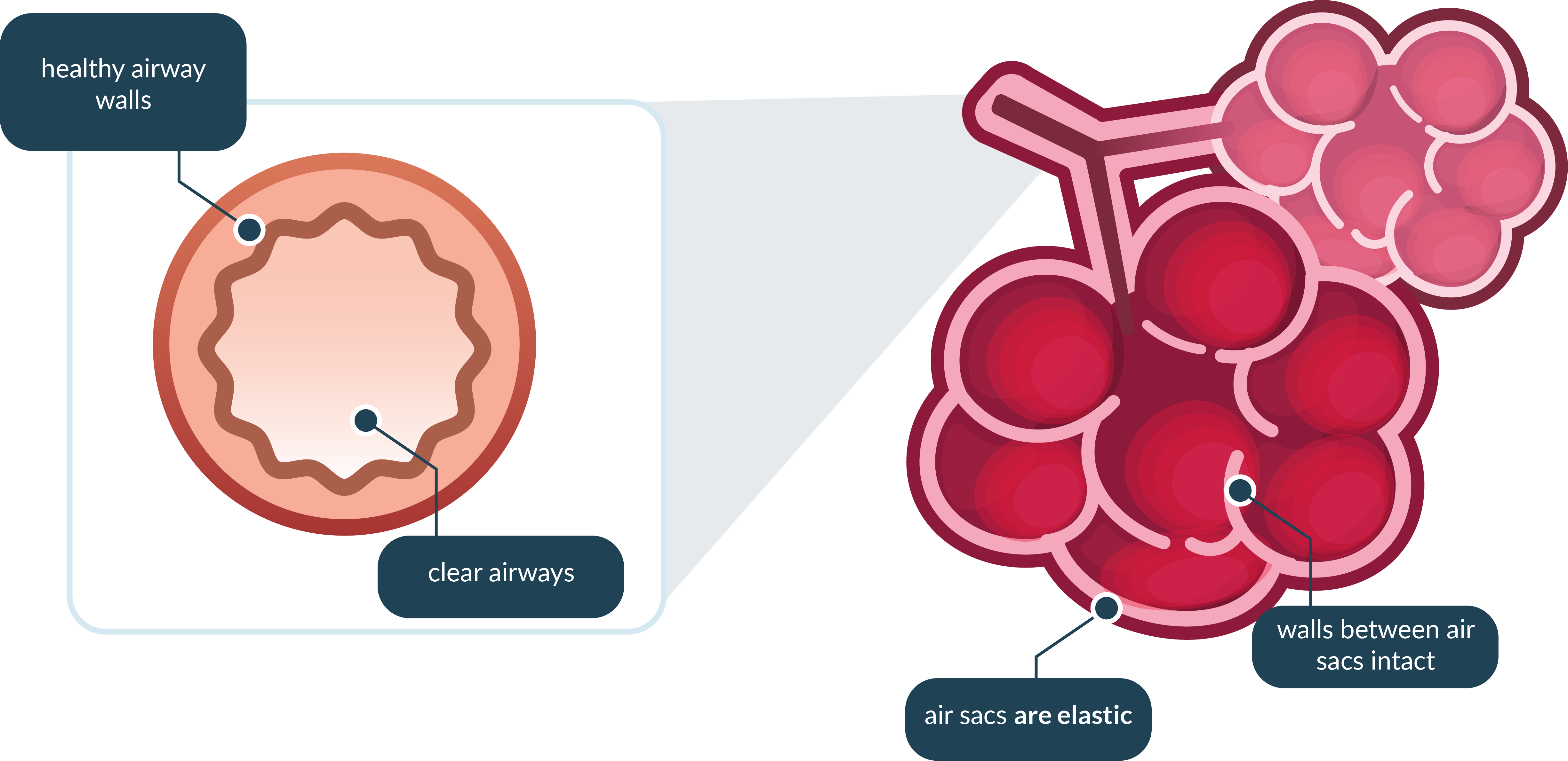 healthy_airway_img